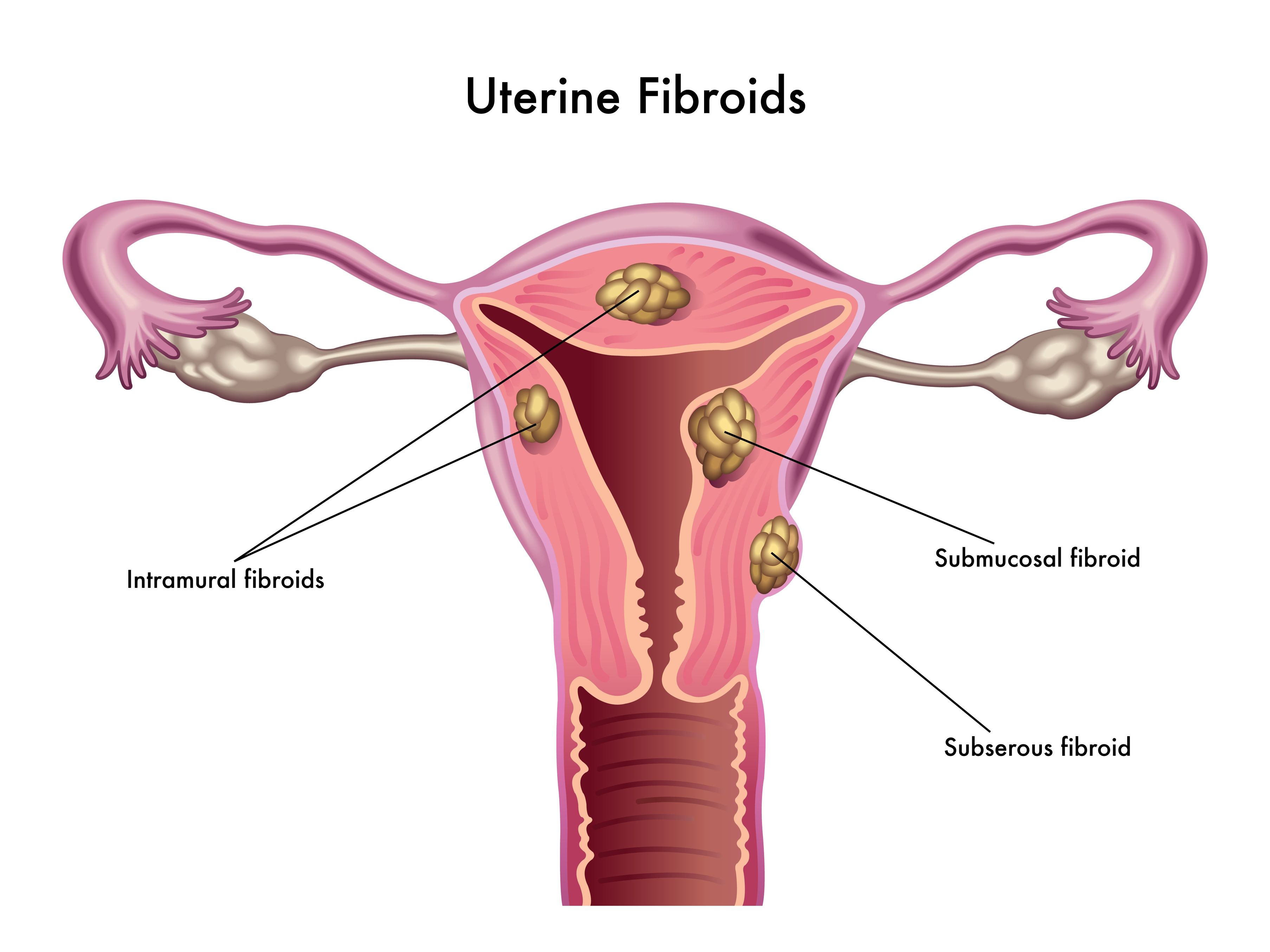 Uterine Fibroids - Integrative treatment options